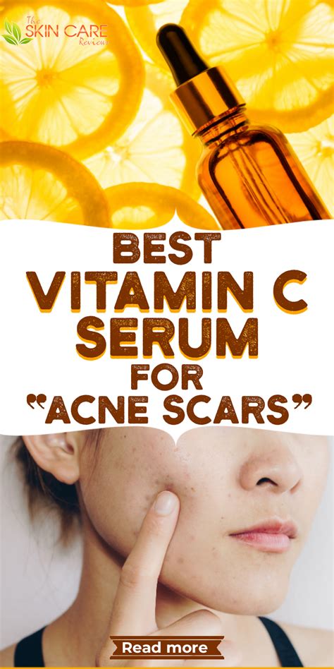 Is Vitamin C Serum Good For Acne Prone Skin? in 2020 | Vitamins for skin, Natural skin care ...