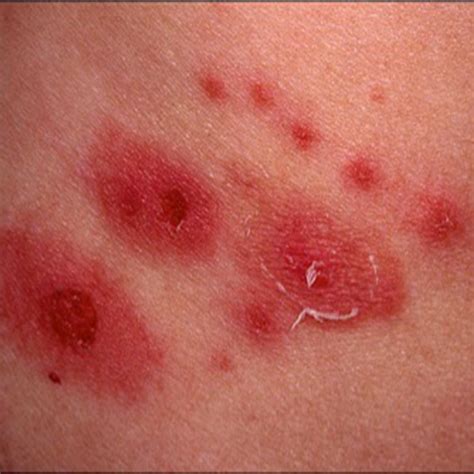 Shingles Symptoms Causes Rash Treatment In Australia - vrogue.co