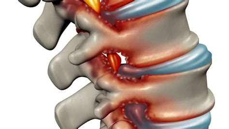 Spinal stenos – orsak, symtom och behandling | Doktorn.com