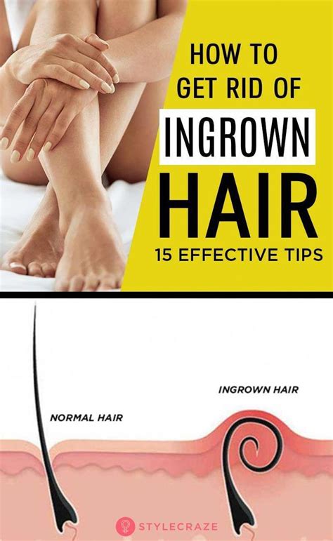 15 Simple Tips To Reduce The Growth Of Ingrown Hair #haircare #tips #hair #FacialHairRemoval ...