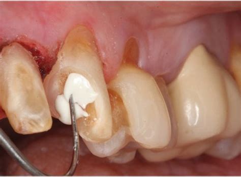 direct and indirect pulp capping Archives - Dentistry Today