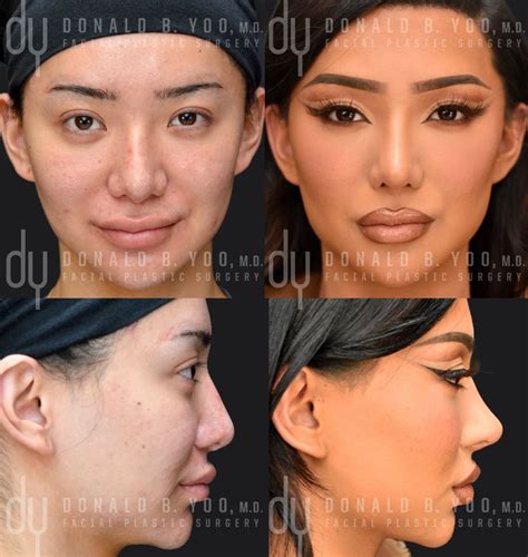 Revision Rhinoplasty with Rib Cartilage | Rhinoplasty, Rhinoplasty surgery, Facial plastic