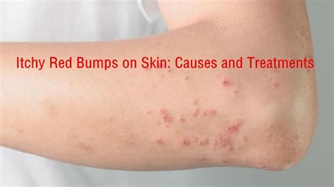 Itchy red bumps on skin allergic reaction – Tbmtb