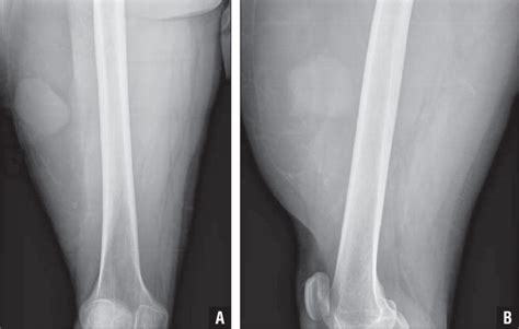 Liposarcoma