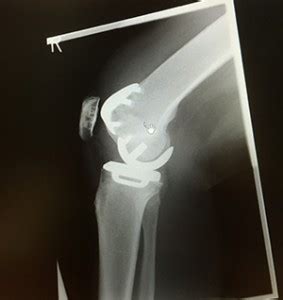 Unicondylar Knee Joint Replacement | Buckinghamshire knee surgery