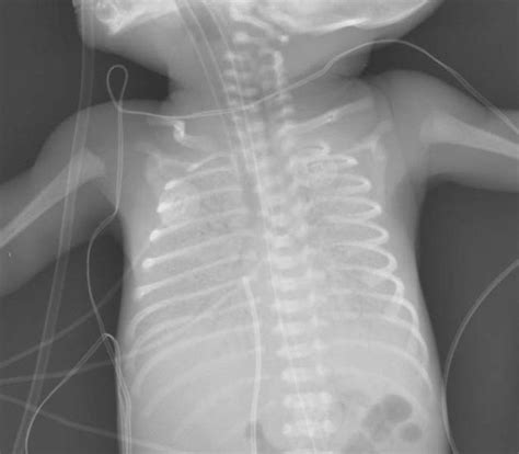 Hyaline membrane disease in a preterm neonate. Virtually no aerated ...