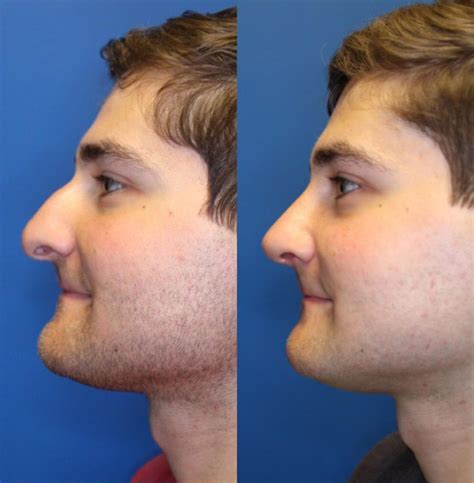 What Is The Cost For Nose Plastic Surgery at johnnybzaleskio blog