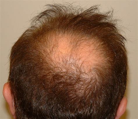 Case-7957 | Leonard Hair Transplant Associates