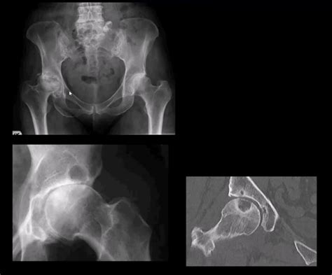 Diagnosis of Hip Complaints: Arthritis & Neoplasms Part I | El Paso, TX.