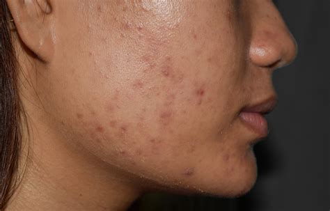 Post-Inflammatory Hyperpigmentation Caused By Acne | Sozo Clinic