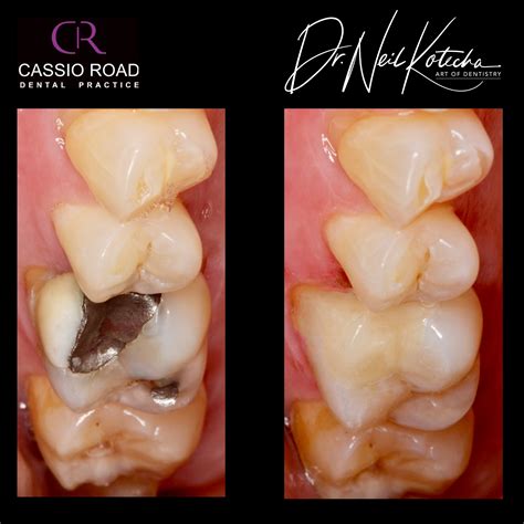 Before & After Composite | Cassio Road Dental Practice : Dental ...