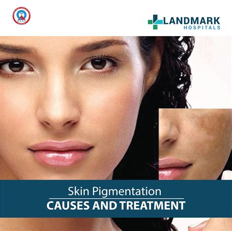 Skin Pigmentation Causes And Treatment – Landmark Hospitals