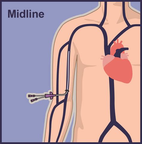 Midline Catheter