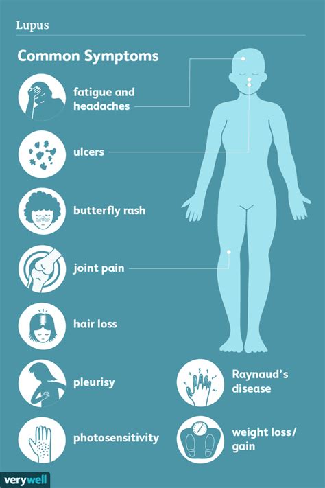 Childhood-Onset Lupus: Overview and More