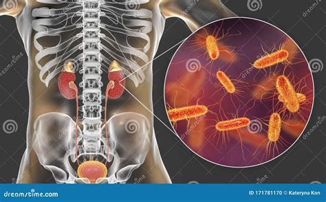 Acute Pyelonephritis Caused by Bacteria Escherichia Coli, Medical ...