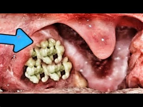 Biggest Tonsil Stones Compilation, Big Tonsil Stones & Tonsilloliths ...