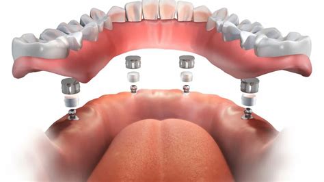 Dental Implant Overdentures: Definition, Types, Benefits, and Cost