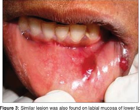 Figure 2 from Epithelioid hemangioma (angiolymphoid hyperplasia with eosinophilia) in the oral ...