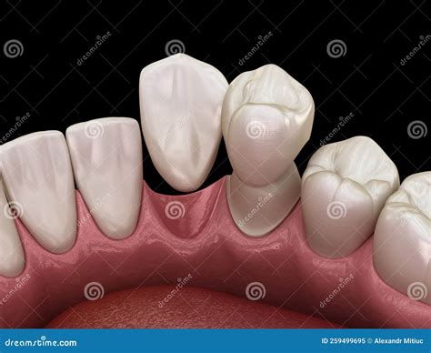 Cantilever Bridge Made From Ceramic, Frontal Tooth Recovery. Medically Accurate 3D Animation Of ...