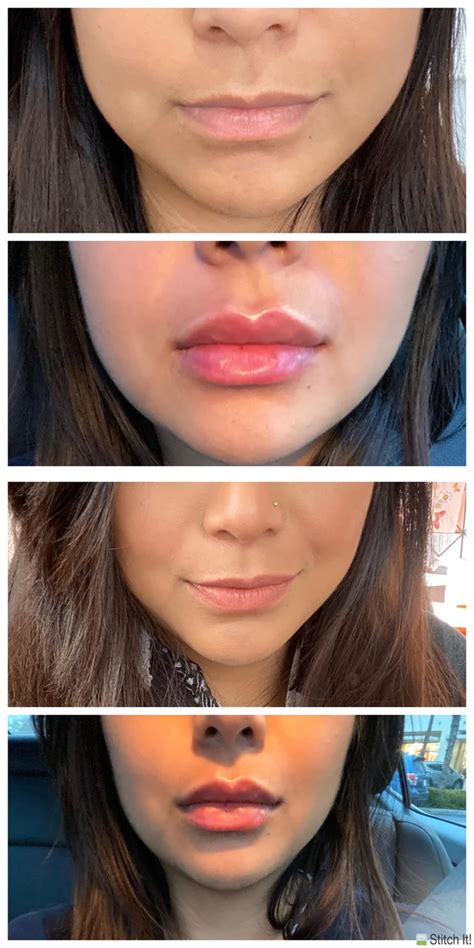 Juvederm before and after – Artofit