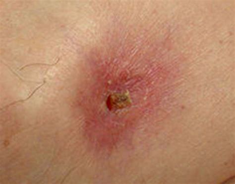 Hidradenitis Suppurativa, a chronic inflammatory condition of the apocrine sweat glands ...