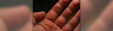 Burning hands sensation | Musculoskeletal Issues articles | Body ...