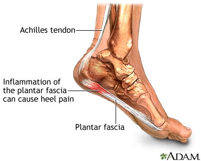 Plantar fasciitis Information | Mount Sinai - New York