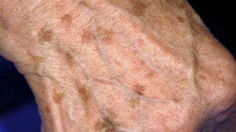 What Is a Macule? | Vitiligo treatment, Post inflammatory hyperpigmentation, Skin disorders