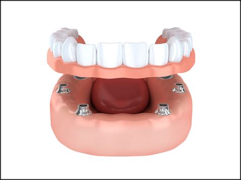 Implant Dentures: Fixed Or Removable - Dental Implants | Coleman Dental