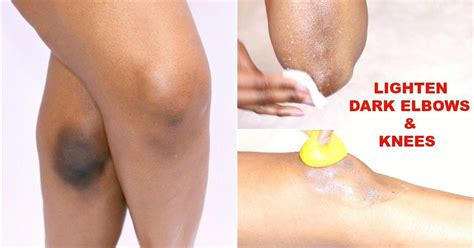 5 ways to naturally get rid of dark elbows and knees | Pulse Nigeria