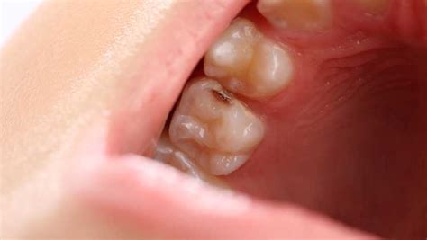 Tooth Cavity Dental Fillings: What To Expect, Kinds & Possible Troubles