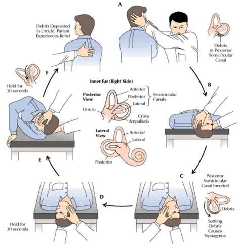 Benign paroxysmal positional vertigo (BPPV) is one of the most common ...