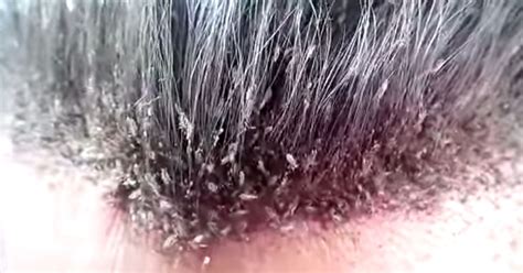 This video of a man's disgusting head lice infestation will make your skin crawl - Irish Mirror ...