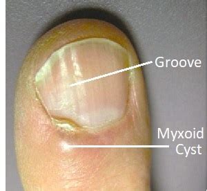 Digital Mucous Cyst: Causes & Treatment for Myxoid Cysts