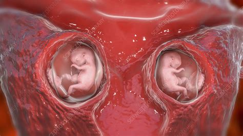 Dizygotic twins, illustration - Stock Image - F034/4565 - Science Photo Library