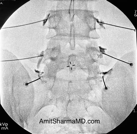 Amit Sharma, MD | Lumbar Facet-Joint Injections | Long Island | NY