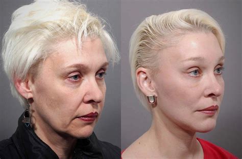 Which Facelift Procedure Is Right For You Westside Fa - vrogue.co