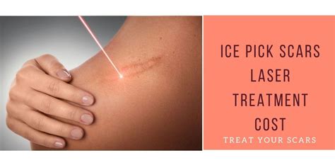 Ice Pick Scars Laser Treatment Cost - Treat Your Scars