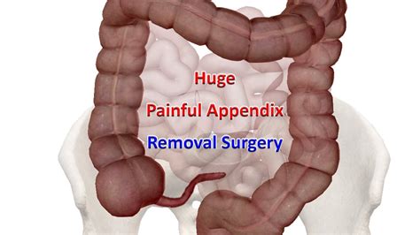 Laparoscopic Appendectomy | Huge Painful Appendix Removal Surgery - YouTube