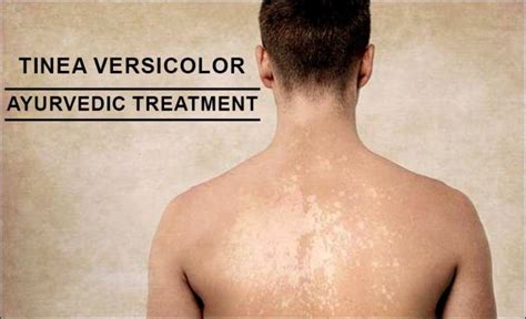 Tinea Versicolor Treatment in Ayurveda - Fastest Way to Cure