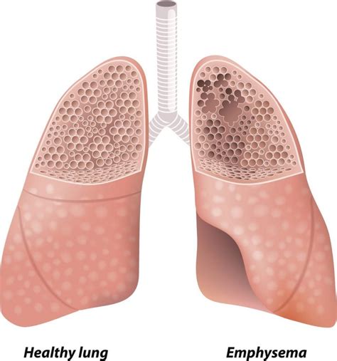 How Emphysema Affects Respiratory System - PELAJARAN