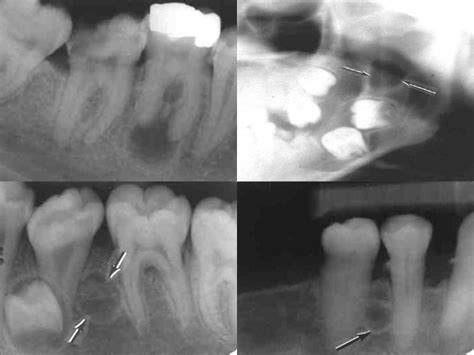 Odontogenic Cysts