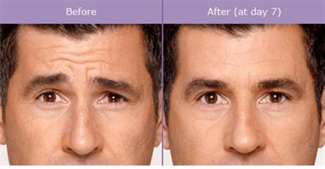 Forehead Wrinkles: Botox or Dermal Fillers | SD Botox