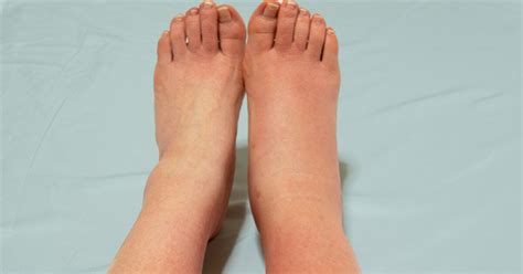 Cellulitis: When to Worry, Symptoms Not to Ignore