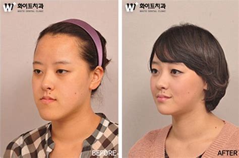 31 Crazy Before And After Photos Of Korean Plastic Surgery | Plastische ...