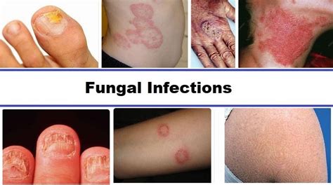 Fungal Infections: Causes, Symptoms and Treatment - Helal Medical