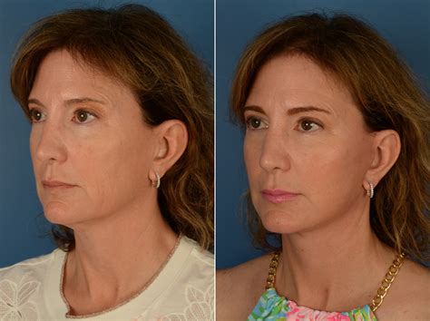 The UpLift™ Lower Face and Neck Lift Photos | Naples, FL | Patient 14515