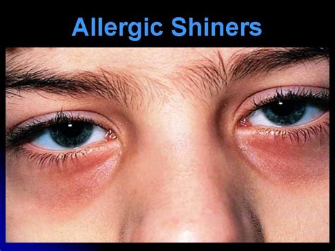 Allergic Rhinitis Dr Vishal Sharma Introduction Commonest chronic