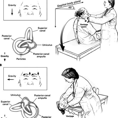 The Semont maneuver for right-sided BPPV. (1 ) Patient is seated in the... | Download Scientific ...