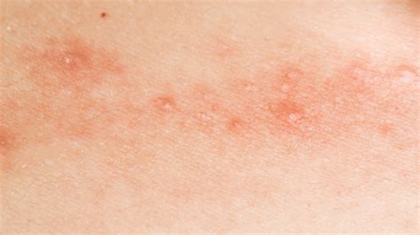 groin acne - pictures, photos